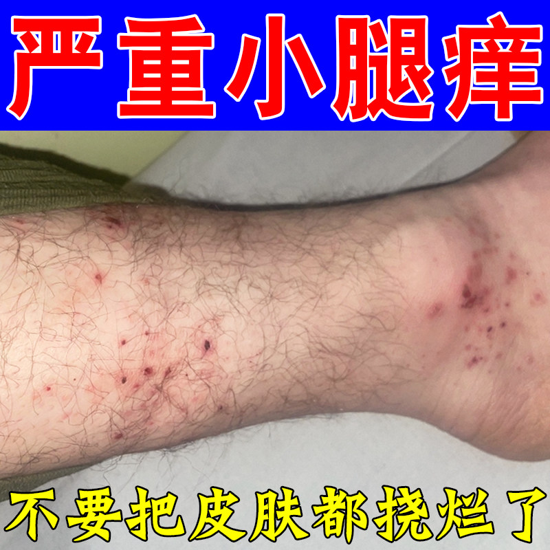 腿痒小腿皮肤长小红点疙瘩痒腿干燥起皮秋冬天换季性身上痒乳膏