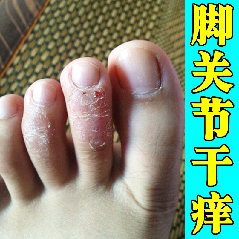 脚趾关节干痒起皮专用软膏冶换季脚痒真菌手足干裂起白色鳞屑痒药