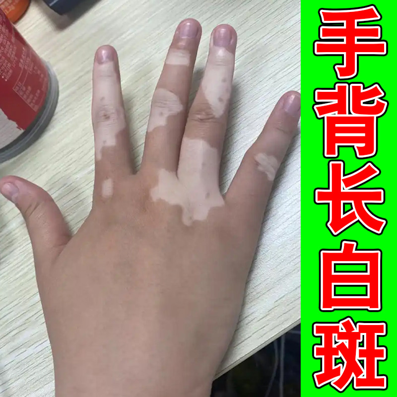 手背长白斑外用修复软膏促进黑色素生长补骨脂酊手上起白色斑块