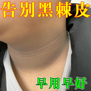 脖颈变白神器去脖子黑色素沉淀黑棘皮洗不干净除专用按摩膏