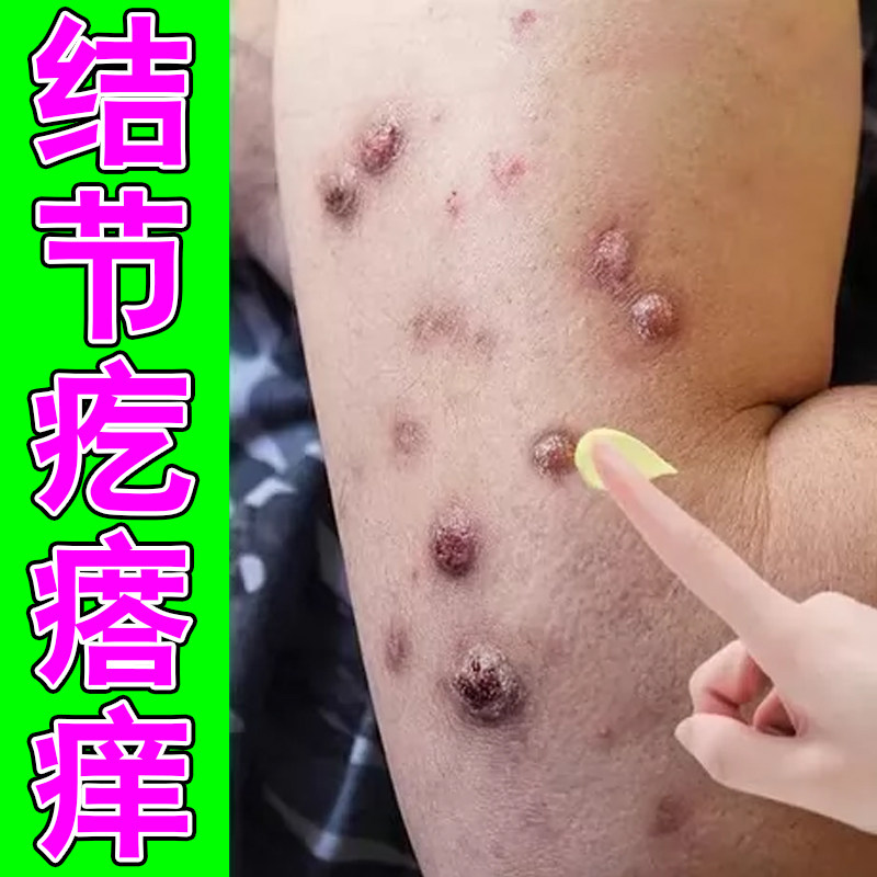 结节疙瘩手臂胳膊腿上长硬块丘疙瘩四肢干燥起皮掉屑硬疙瘩痒专用