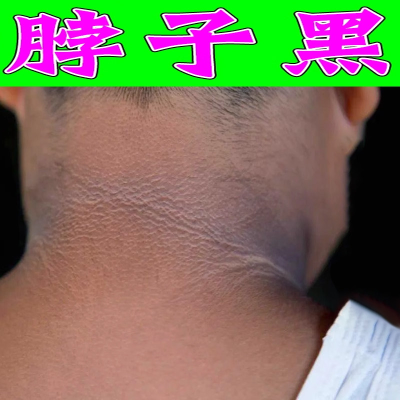 去后脖颈黑脖子黑色素沉淀洗不干净黑全身除脖子手肘关节膝盖黑黑