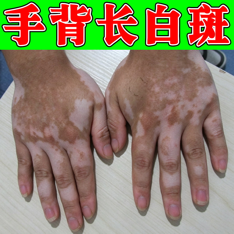 手背长白斑儿童成人肤色不均色素脱失补骨脂酊促进黑色素生长