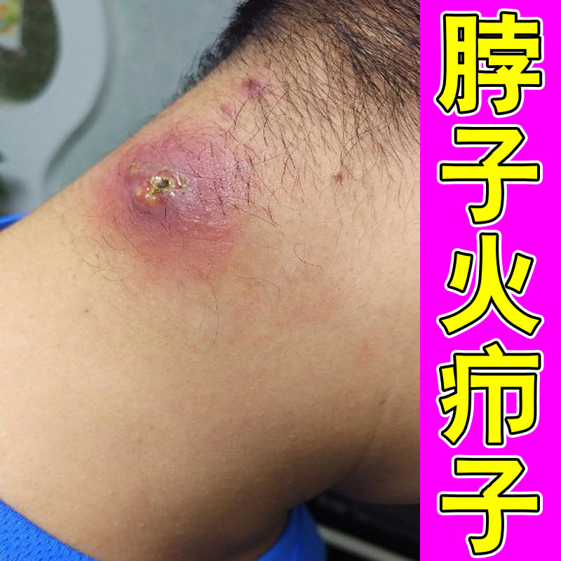 脖子后面长火疖子红肿疼痛红斑疙瘩硬块脓包毛囊堵塞大包红痒软膏