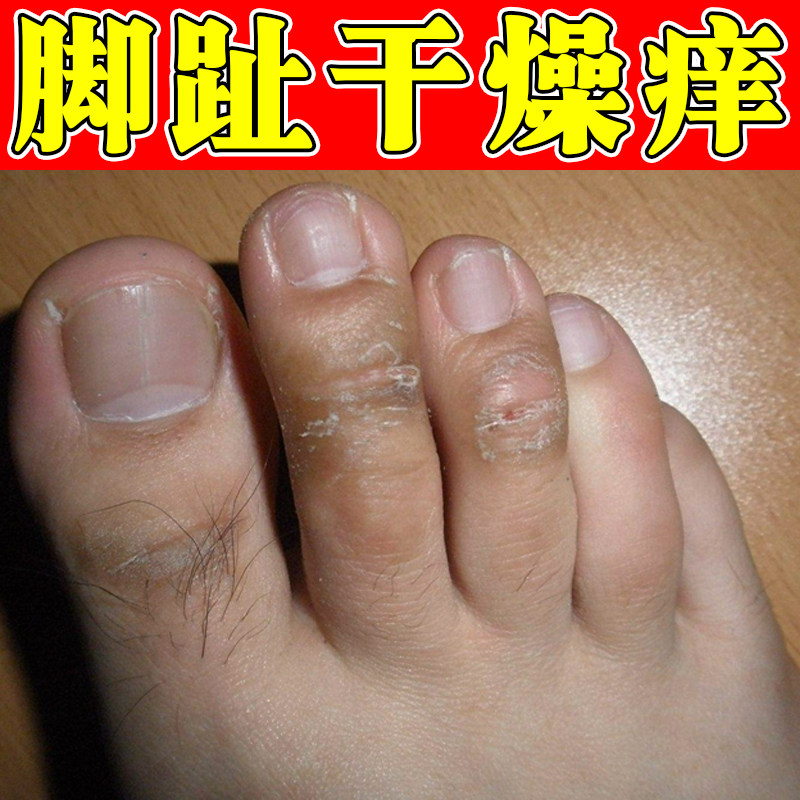 脚趾干燥痒脱皮掉屑脚指头关节角质增厚黑色素沉淀脚干痒专用软膏