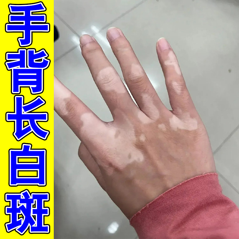 手背长白斑补骨脂酊修复促进黑色素生长手上白色斑块汗斑花斑