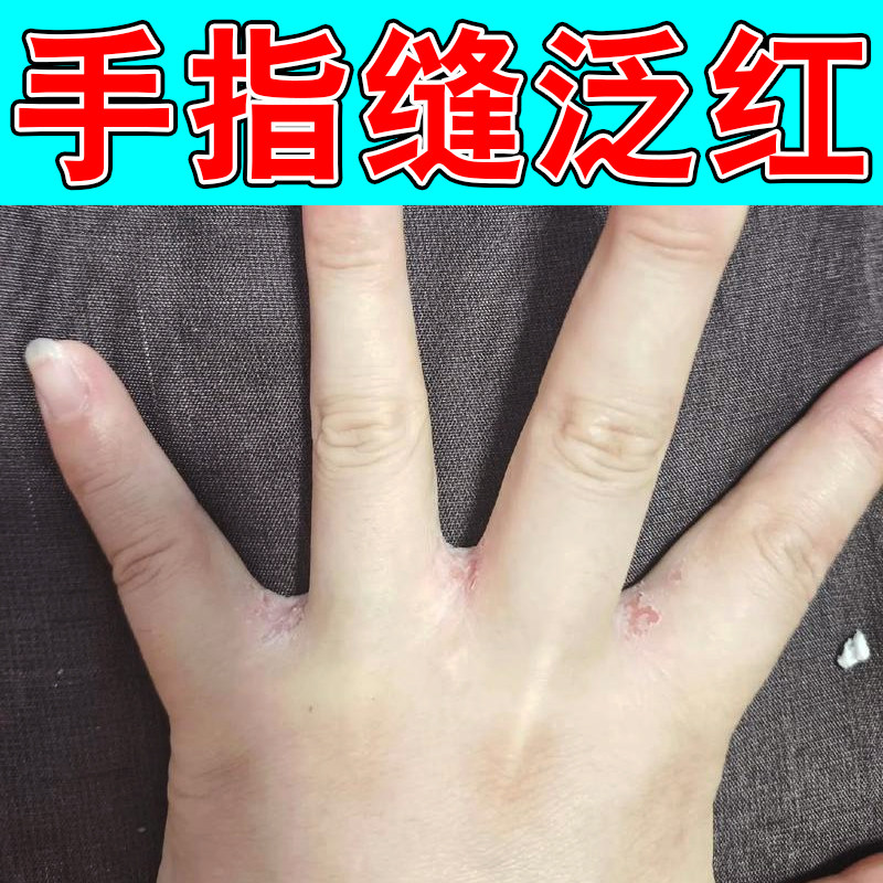手指缝痒改善指缝肌肤干痒起小颗粒洗完手发痒指缝皮肤紧绷粗糙痒