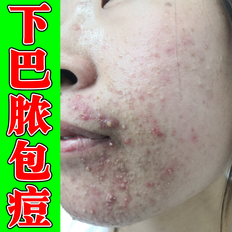 下巴脓包痘熬夜上火长痘内分泌失调火气痘疼痛红肿去小疙瘩痘