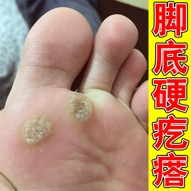 脚底硬疙瘩干燥粗糙按压走路有疼痛感脚长疙瘩茧子