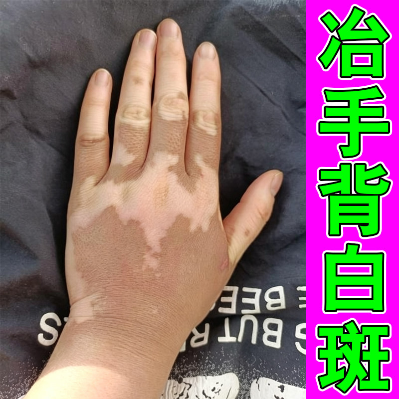 冶手背长白斑的药外用修复男女通用手上起白点促进黑色素生长
