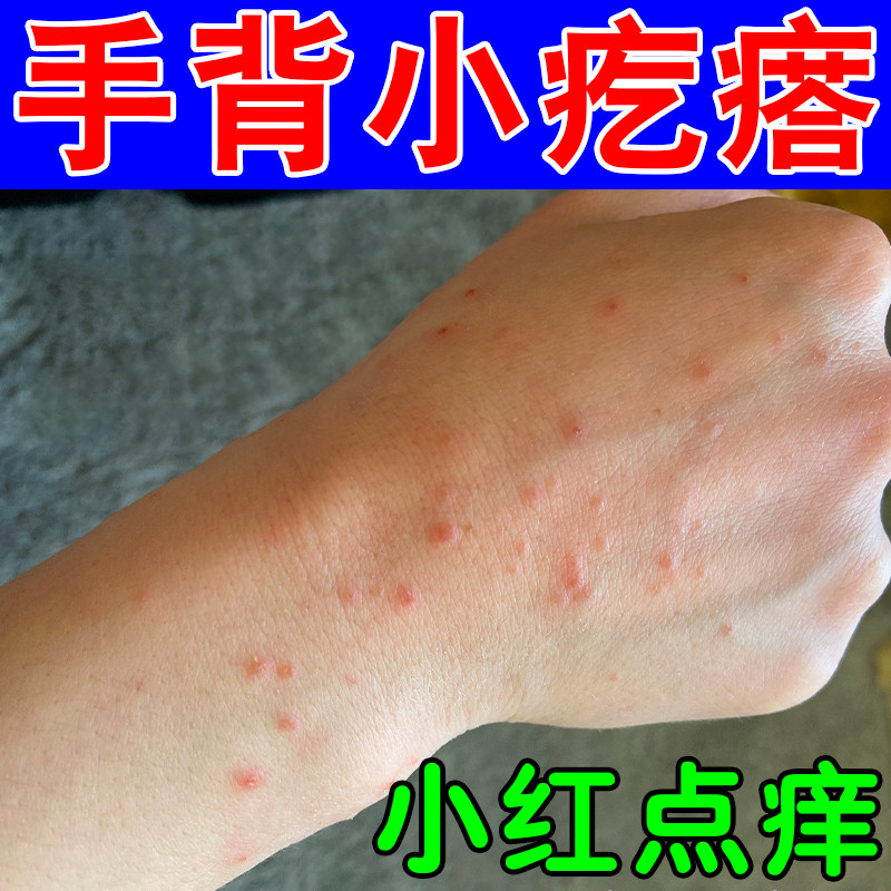 手背长小疙瘩手上起小红点疙瘩身上起红疙瘩外用手背小疙瘩痒软膏