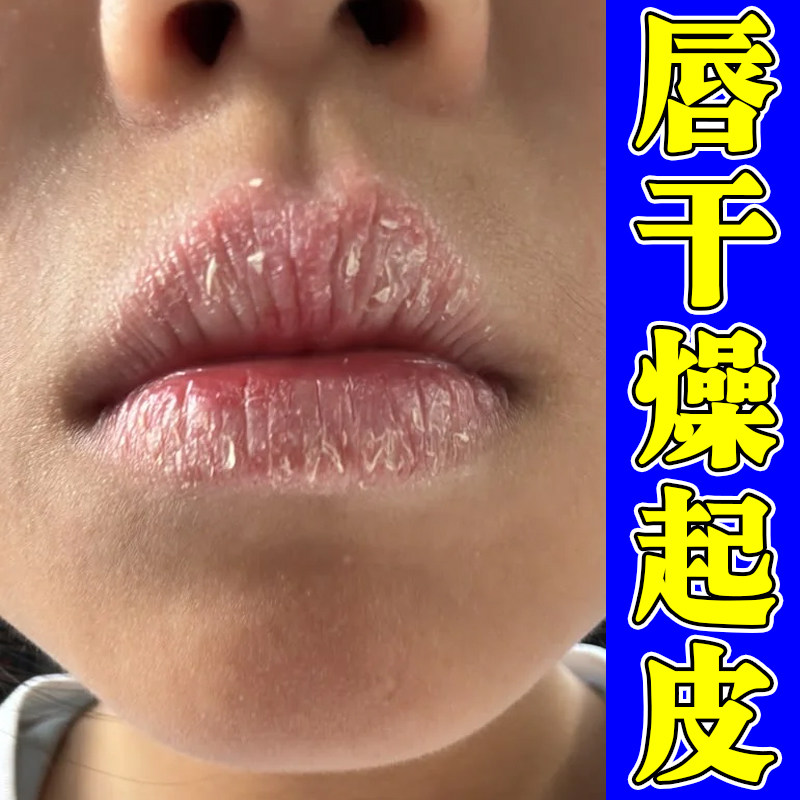 嘴唇干裂起皮嘴角起屑嘴巴发干脱皮干燥唇部紧绷起干皮保湿软膏药