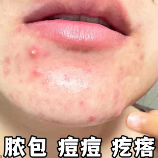下巴长痘痘有脓包红肿疼痛上火痘疙瘩痘痘闭口脓包痘印青春痘乳膏