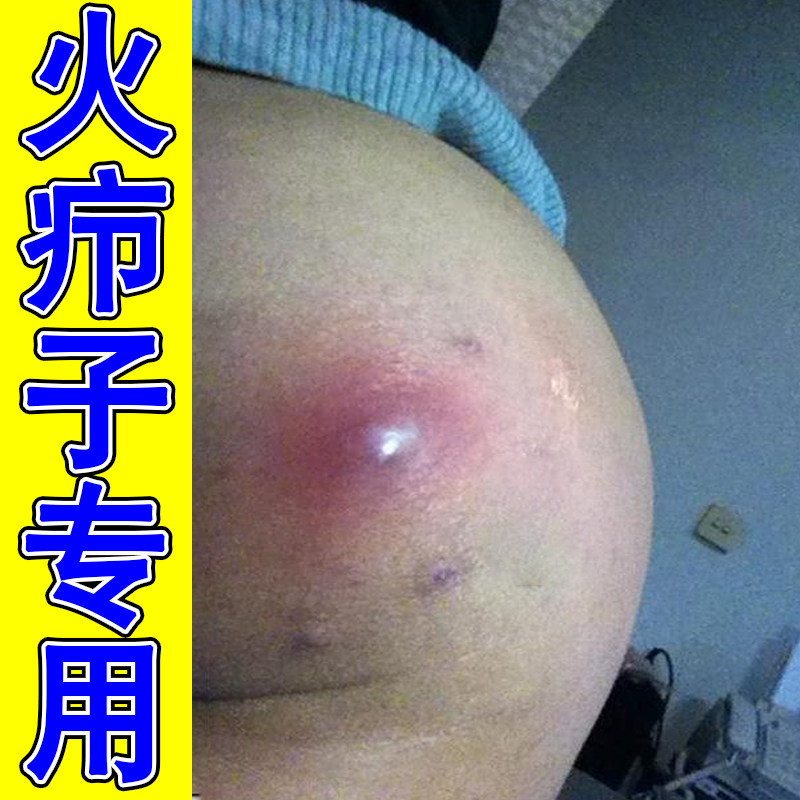 火疖子专用软膏屁股上长痘痘痒起热疙瘩红肿久坐坐板出汗刺挠痒药