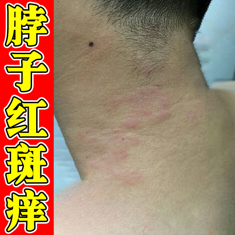 脖子红斑痒换季脖颈后面出汗刺挠痒脖子痒干燥粗糙起小红疙瘩软膏