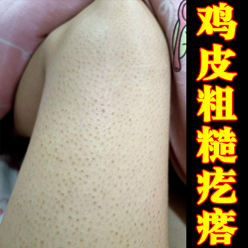 鸡皮粗糙颗粒腿上密密麻麻的小红点黑点毛囊堵塞修复鸡皮疙瘩乳膏