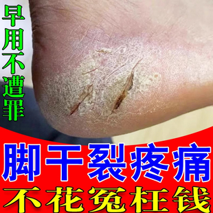 脚后跟干裂疼痛鳞屑脚丫痒药脚底板干掉皮糜脚趾裂口开裂修复药霜