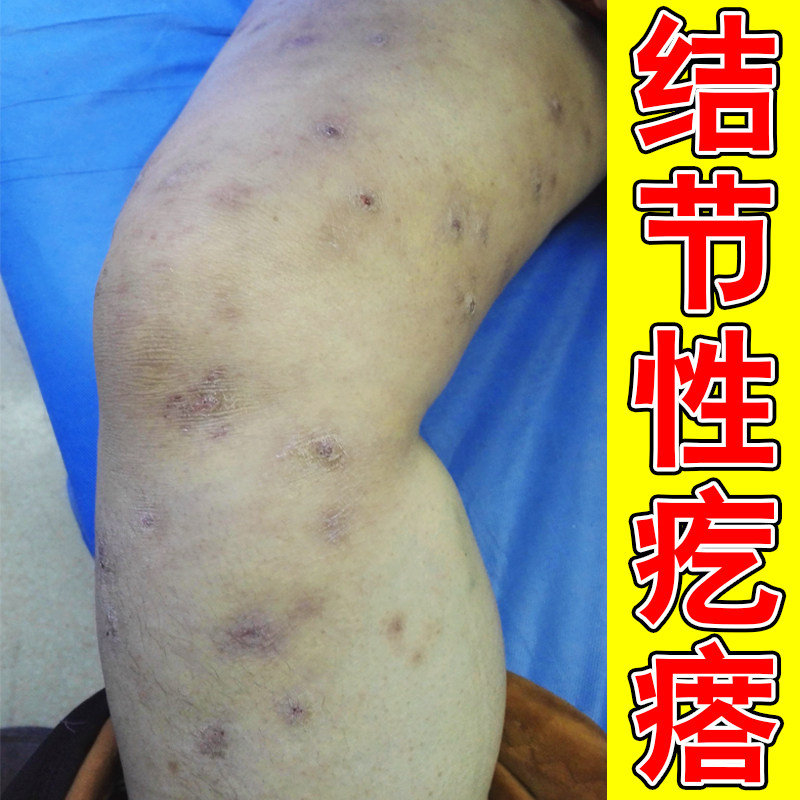 结节性疙瘩干燥粗糙皮肤过敏痒蚊虫叮咬色素沉淀小腿痒硬块疙瘩