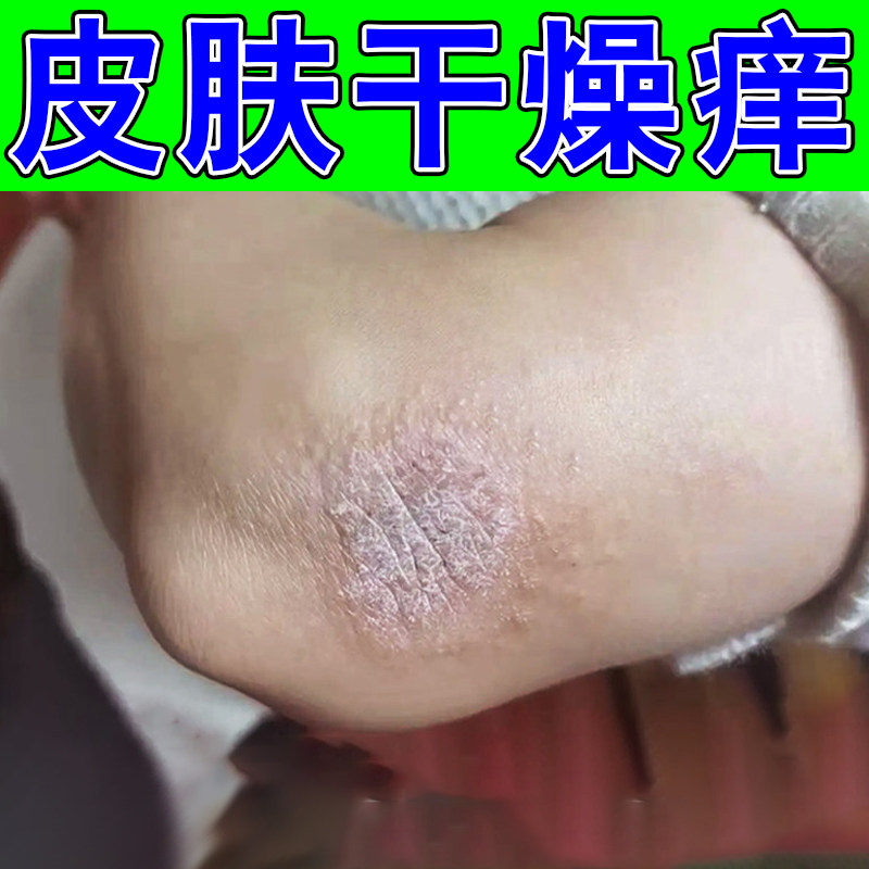 皮肤干燥痒外用修复手肘关节干痒粗糙长小疙瘩一挠就痒起皮掉屑痒