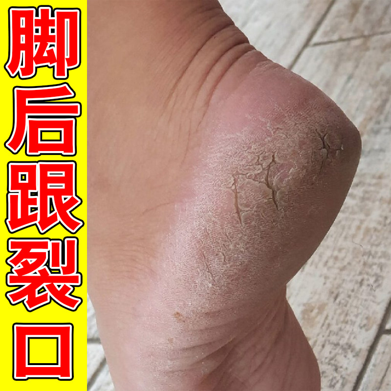 脚后跟裂口干燥起硬皮冶足跟干裂专冶手脚起皮掉屑脱皮外用修复霜