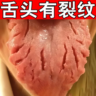 舌头裂纹沟纹舌喷雾剂舌头有齿痕舌苔厚白嘴舌头开裂外用喷剂