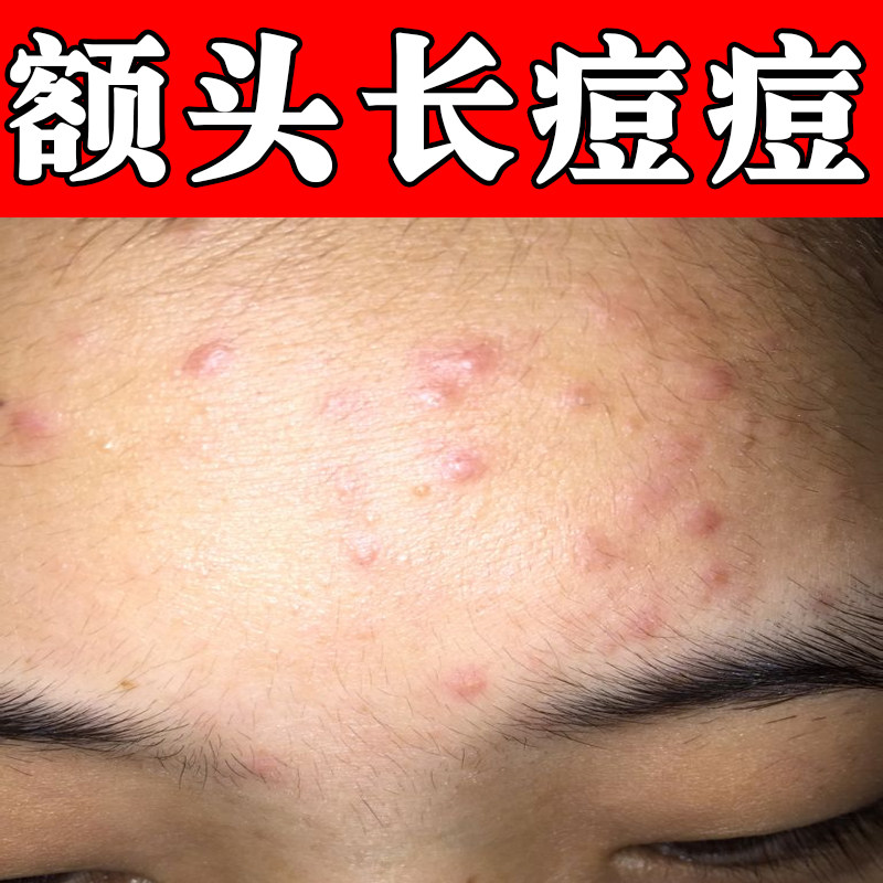 额头长痘痘青春痘男女学生专用熬夜上火长痘内分泌失调外用膏
