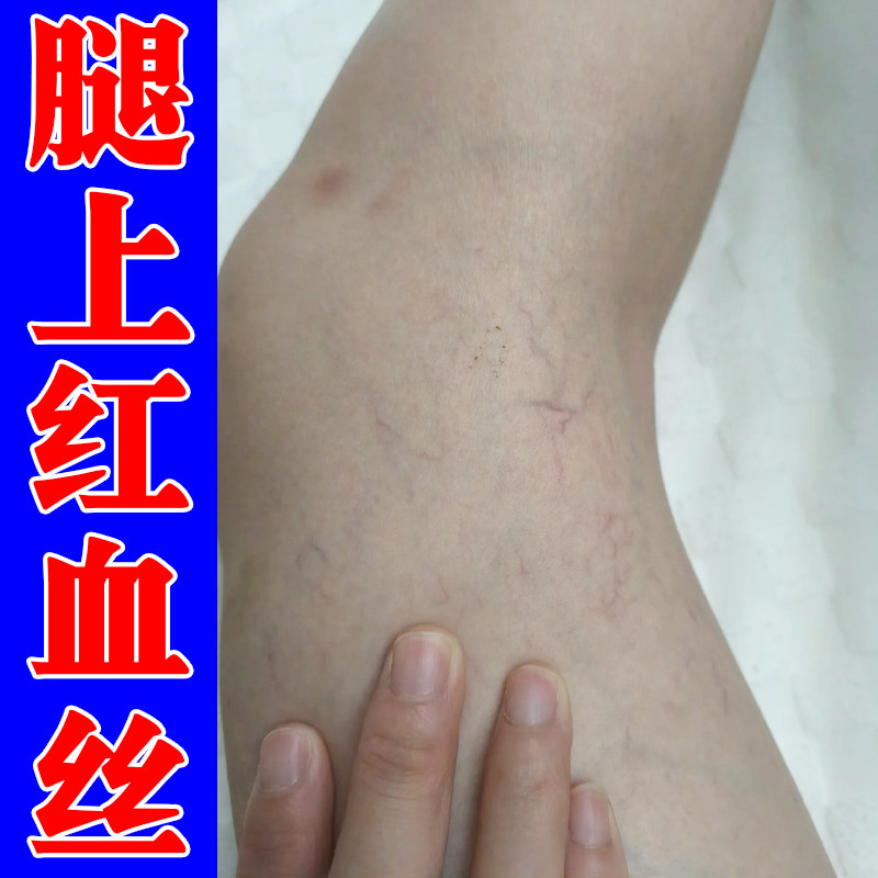 毛细血管扩张修复久站久坐下肢酸胀不适血管不流通腿上有红血丝