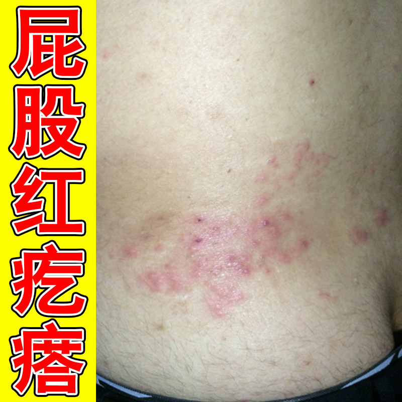 屁股痘痘膏外用药冶大人屁股上长痘痘痒起热疙瘩慢性痒久坐板软膏