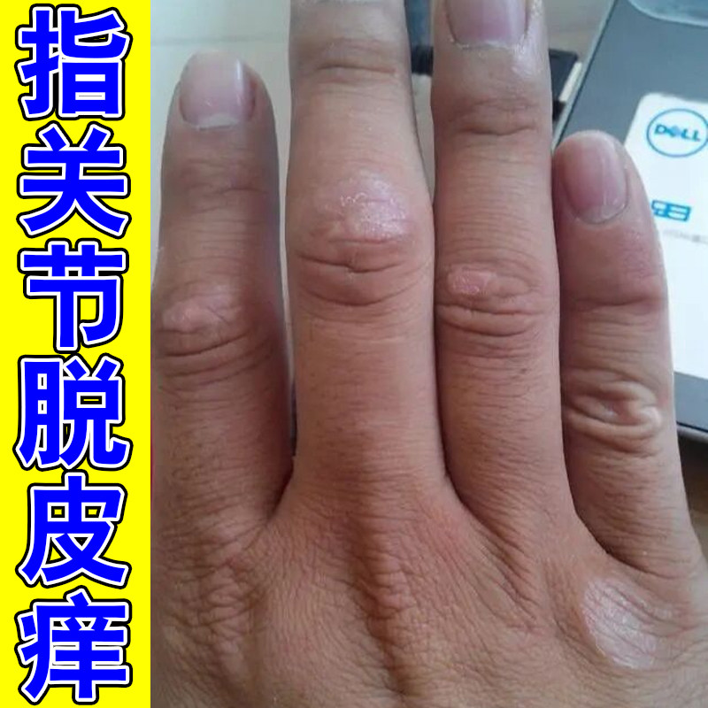 手指关节脱皮痒干燥粗糙起皮掉屑真菌手脚干裂神经性皮肤痒软膏