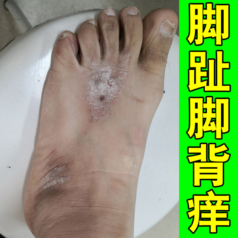 脚趾脚背痒干燥粗糙起皮掉屑长小红点疙瘩白色鳞屑痒真菌脚痒的药