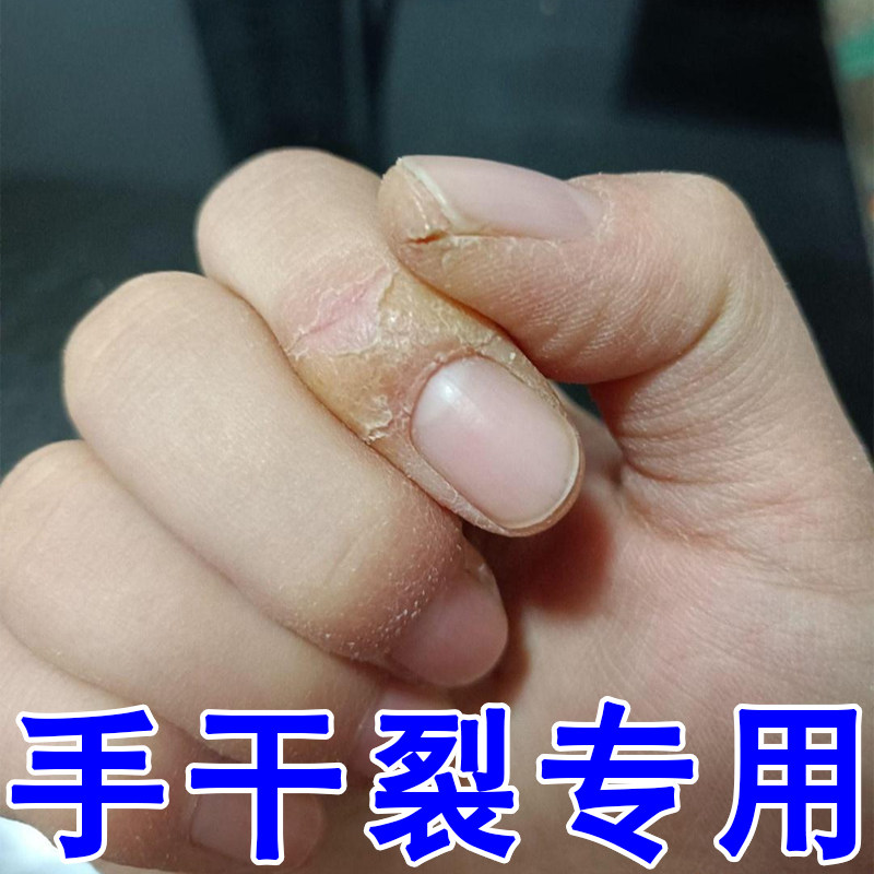 手干裂专用软膏手指关节痒干燥粗糙起硬皮疙瘩裂口子药季节手脱皮