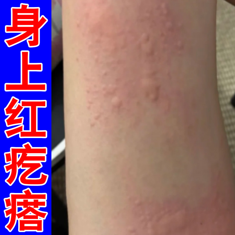 身上小疙瘩专用皮肤痒过敏丘痘痘腿上疙瘩后背痒起小红点水泡痒药