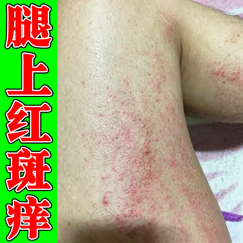 腿上红斑痒过敏皮肤长小疙瘩秋冬天天气冷小腿干燥粗糙痒专用喷雾