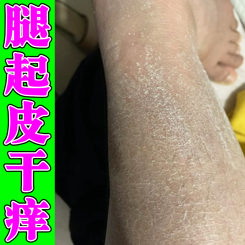 小腿皮肤干燥粗糙起皮掉屑腿腹鳞片状皮屑换季脱屑睡前腿部刺痒干