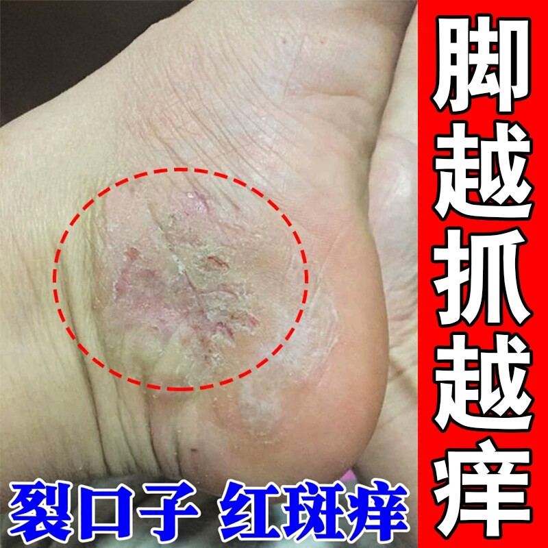 脚底起小水泡又痒又脱皮脚丫脚背痒脚臭皮肤越抓越痒干燥粗糙干裂
