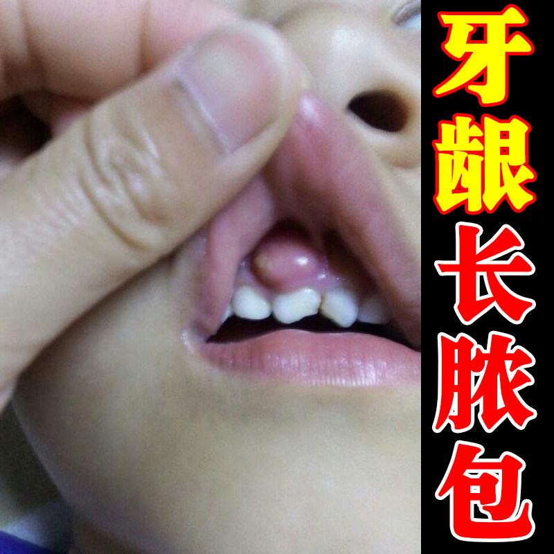 牙龈长脓包肿痛专用喷剂口腔黏膜牙周上火鼓包牙根起软疙瘩修复药