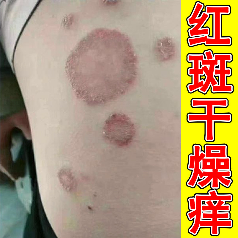 红斑干燥痒后背长圆形铜钱疙瘩真菌皮肤小腿痒干燥粗糙起皮痒专用