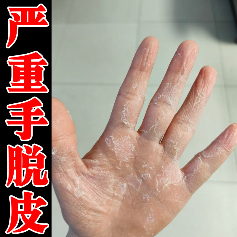 手严重脱皮专用膏手指掉皮手掌起皮皮肤粗糙干燥换季手脱屑干裂药