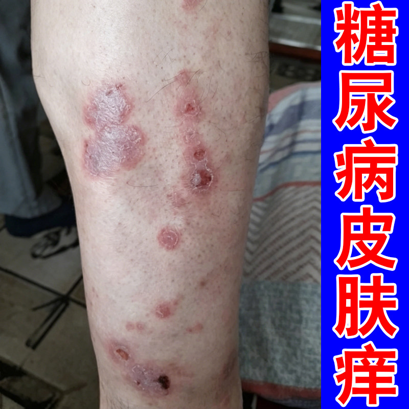 糖尿皮肤痒药身上干燥起皮长红斑疙瘩老年人皮肤粗糙干痒外用软膏