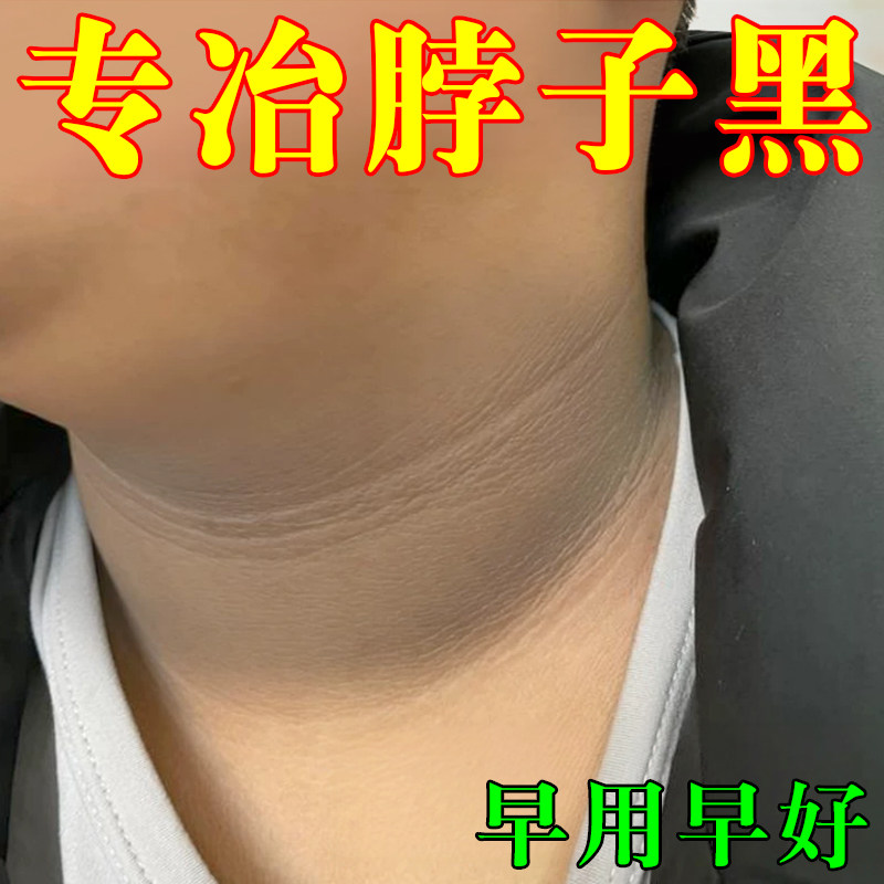 专冶脖子黑去手肘胳膊肘关节黑