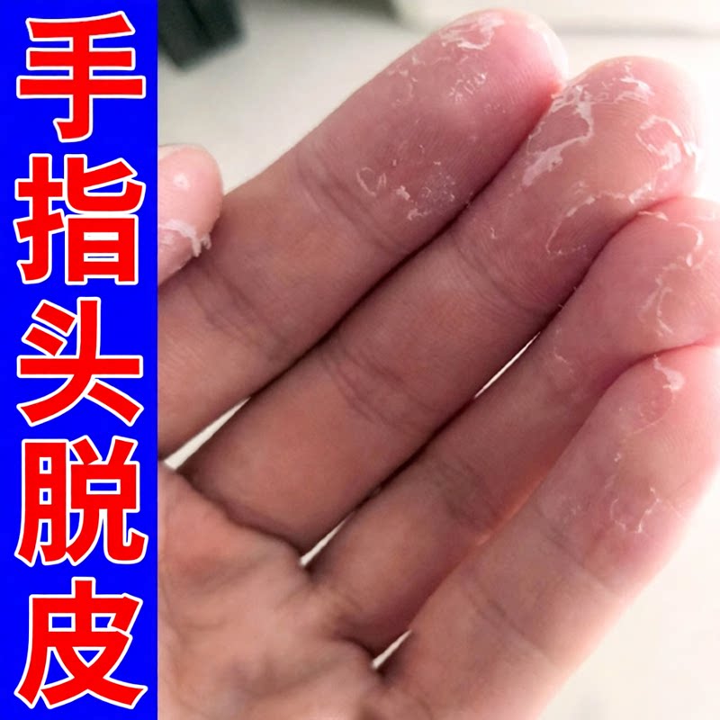 手脱皮手指头脱皮专用冶疗真菌手脚蜕皮干燥起皮皮肤粗糙掉皮膏药