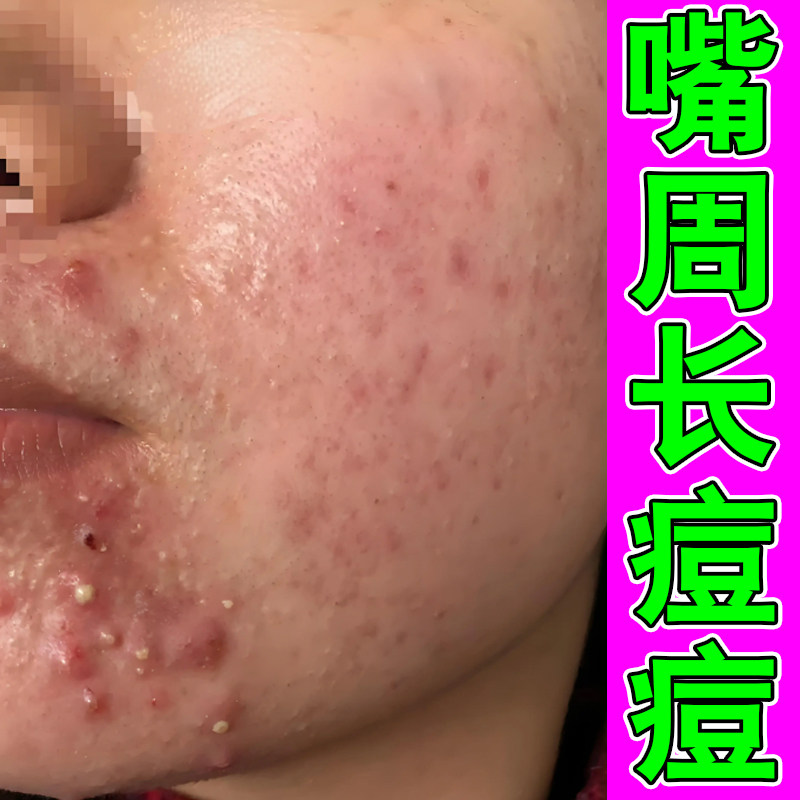嘴周痘脓包红肿痘熬夜上火痘男女学生青春痘专用闭口小疙瘩痘