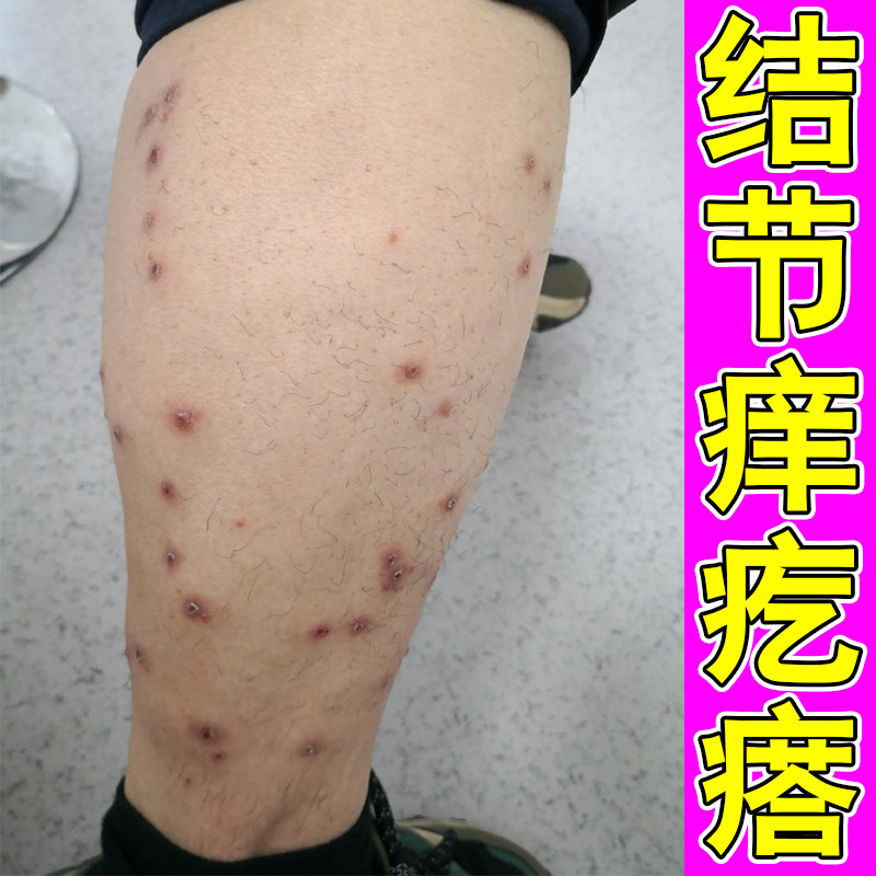 结节痒疙瘩小腿干燥粗糙长硬结红肿丘硬块痘全身皮肤过敏痒外用药