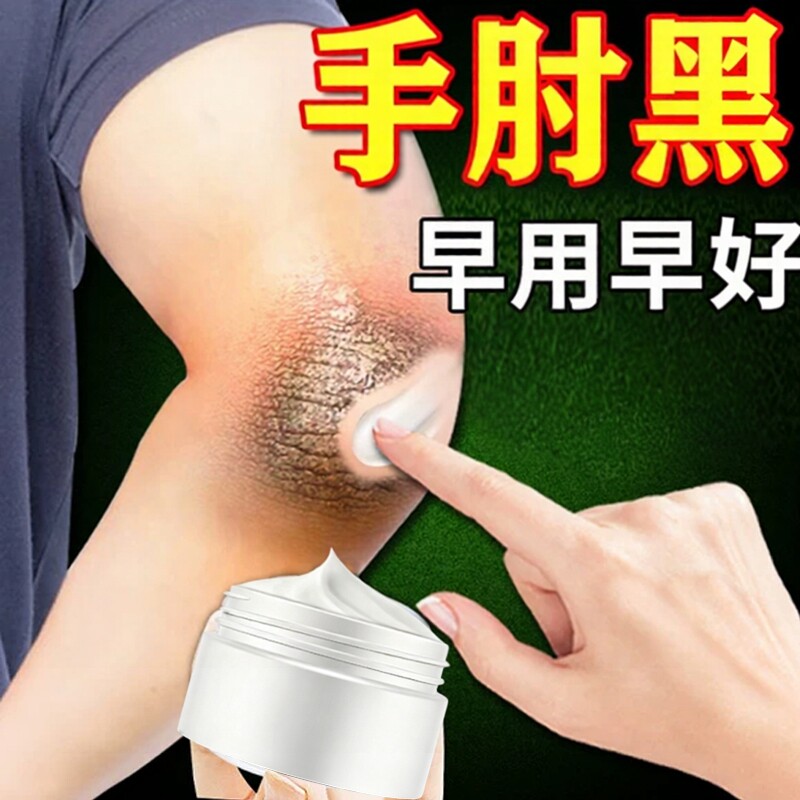 去胳膊肘黑脖子去死皮肤黑色素沉淀药除手肘黑膏膝关节手肘黑神器