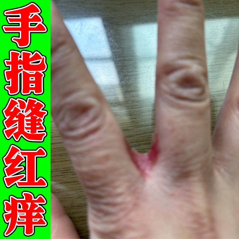 手指缝红痒沾水难受指缝起小水泡皮肤粗糙干燥脱皮痒真菌手痒软膏