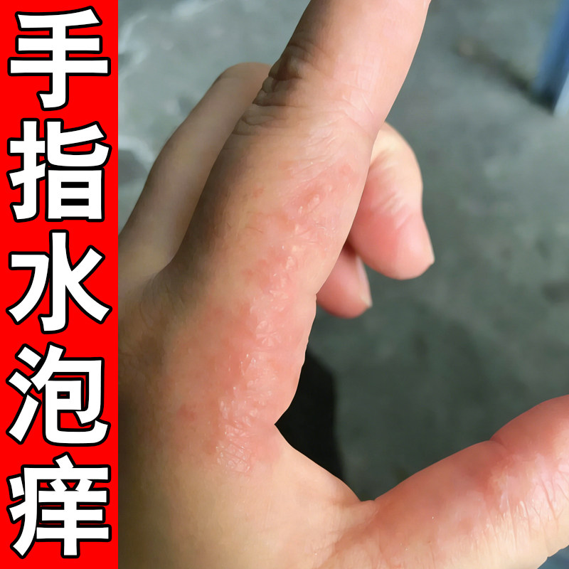 手痒起小水泡痒脱皮汗状痒过敏手上脱皮痒季节性手痒膏