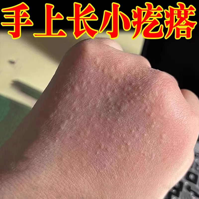 小疙瘩外用药手背痒长疙瘩手上乳膏手上长小点疙瘩颗粒痒