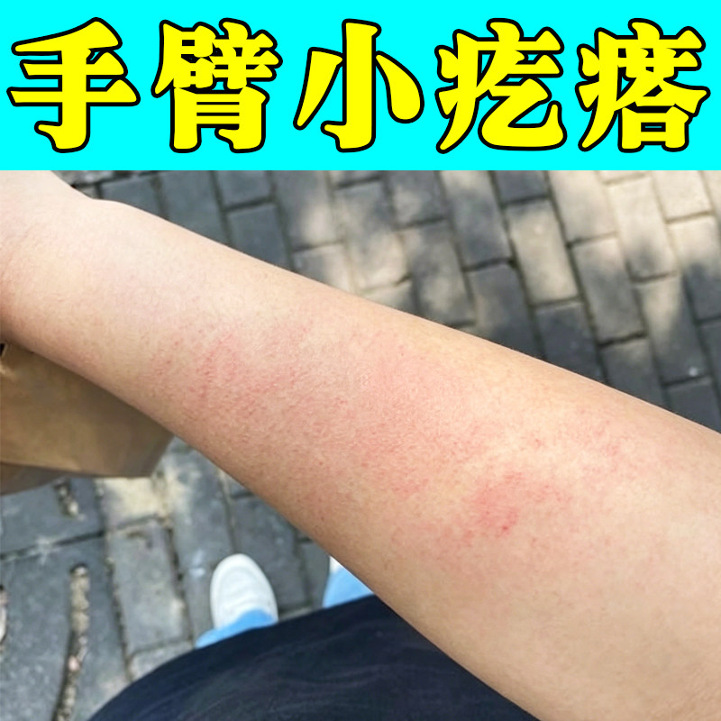 手臂小疙瘩痒外用修复日光性皮肤痒紫外线过敏身上痒胳膊泛红痒膏