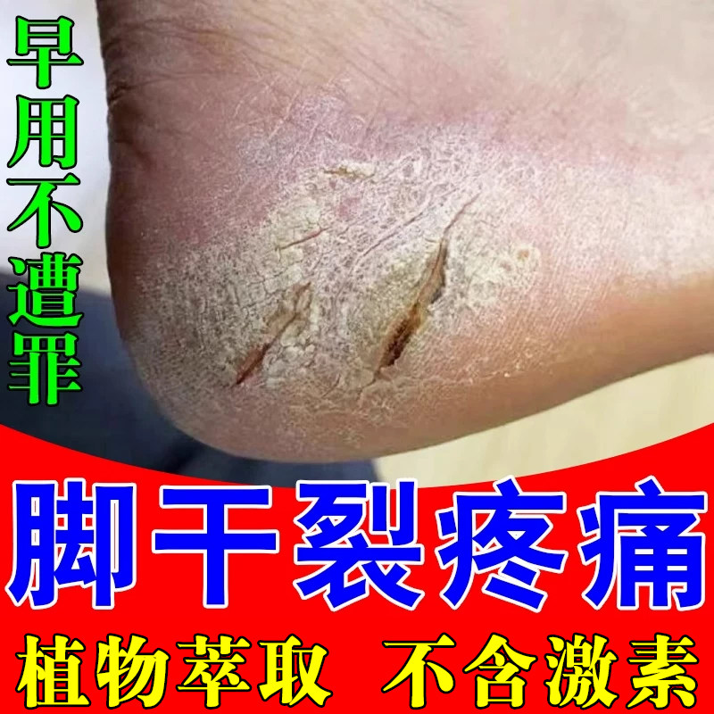 脚后跟干裂疼痛鳞屑脚丫痒药脚底板干掉皮糜脚趾裂口开裂修复药霜