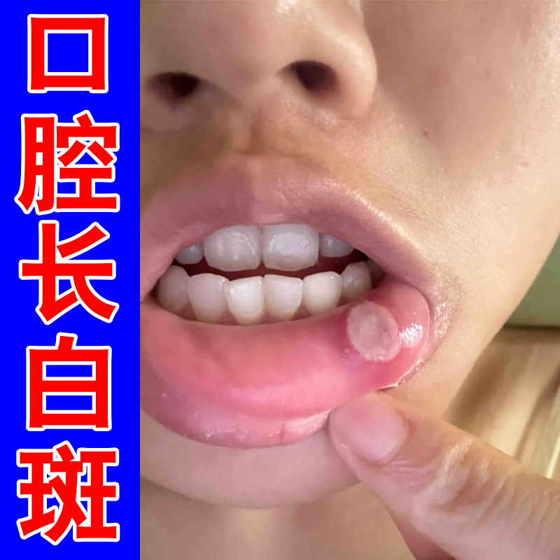 口腔白斑疼痛念珠菌嘴巴内壁红斑白泡破口疼痛上火嘴巴专用喷雾剂